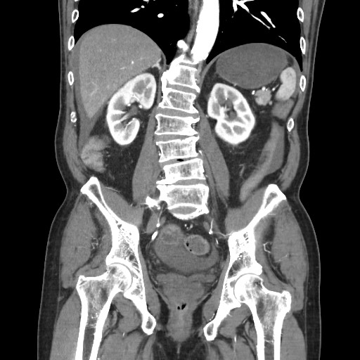 File:Closed loop obstruction due to adhesive band, resulting in small bowel ischemia and resection (Radiopaedia 83835-99023 C 81).jpg