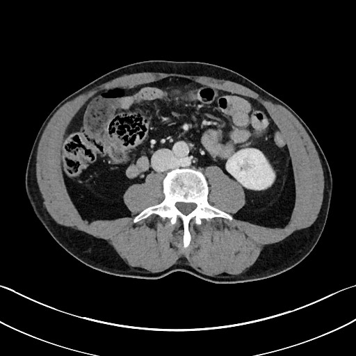 Closed loop small bowel obstruction - internal hernia (Radiopaedia 57806-64778 B 67).jpg