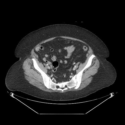 Closed loop small bowel obstruction - internal hernia (Radiopaedia 65402-74450 A 103).jpg