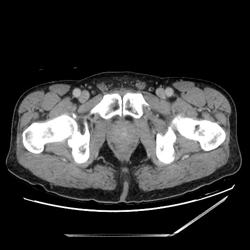 File:Closed loop small bowel obstruction - omental adhesion causing "internal hernia" (Radiopaedia 85129-100682 A 172).jpg