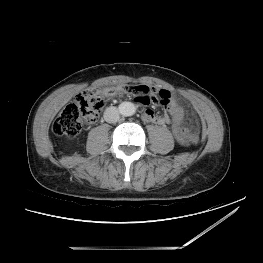 Closed loop small bowel obstruction - omental adhesion causing "internal hernia" (Radiopaedia 85129-100682 A 96).jpg