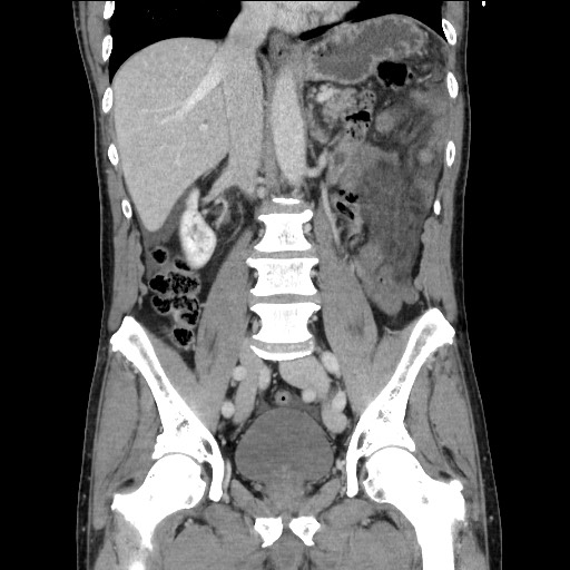 Closed loop small bowel obstruction - omental adhesion causing "internal hernia" (Radiopaedia 85129-100682 B 71).jpg