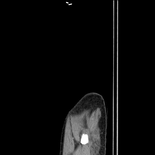 Closed loop small bowel obstruction - omental adhesion causing "internal hernia" (Radiopaedia 85129-100682 C 177).jpg