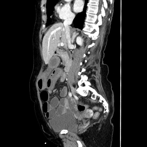 Closed loop small bowel obstruction due to adhesive band, with intramural hemorrhage and ischemia (Radiopaedia 83831-99017 D 91).jpg