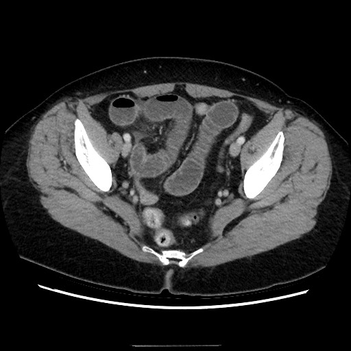 Closed loop small bowel obstruction due to adhesive bands - early and late images (Radiopaedia 83830-99015 A 141).jpg