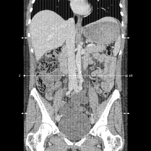 File:Closed loop small bowel obstruction due to trans-omental herniation (Radiopaedia 35593-37109 C 1).jpg
