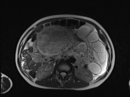 File:Closed loop small bowel obstruction in pregnancy (MRI) (Radiopaedia 87637-104031 Axial T2 32).jpg