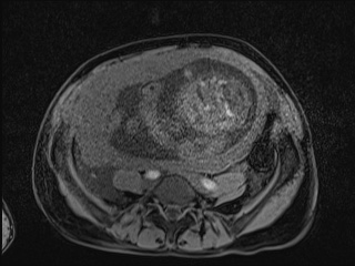 Closed loop small bowel obstruction in pregnancy (MRI) (Radiopaedia 87637-104031 F 25).jpg