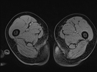 File:Closed loop small bowel obstruction in pregnancy (MRI) (Radiopaedia 87637-104031 G 52).jpg