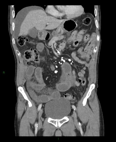 Closed loop small bowel obstruction with ischemia (Radiopaedia 84180-99456 B 42).jpg