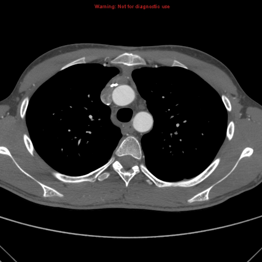 File:Coarctation of the aorta (Radiopaedia 9434-10118 A 57).jpg