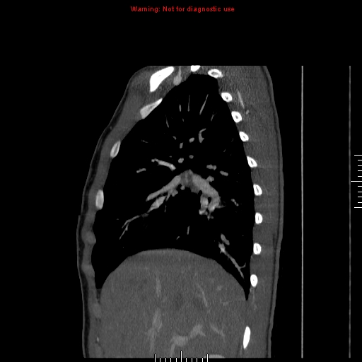 File:Coarctation of the aorta (Radiopaedia 9434-10118 B 10).jpg