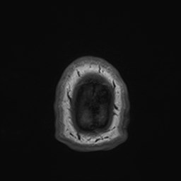 File:Cochlear incomplete partition type III associated with hypothalamic hamartoma (Radiopaedia 88756-105498 Axial T1 190).jpg