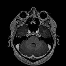 Cochlear incomplete partition type III associated with hypothalamic hamartoma (Radiopaedia 88756-105498 Axial T1 C+ 65).jpg