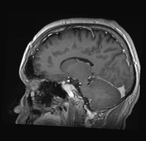 Cochlear incomplete partition type III associated with hypothalamic hamartoma (Radiopaedia 88756-105498 Sagittal T1 C+ 32).jpg