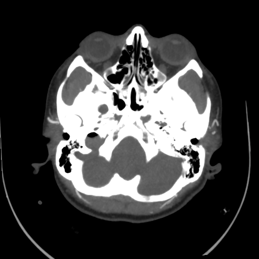 File:Colloid cyst (resulting in death) (Radiopaedia 33423-34499 A 11).png
