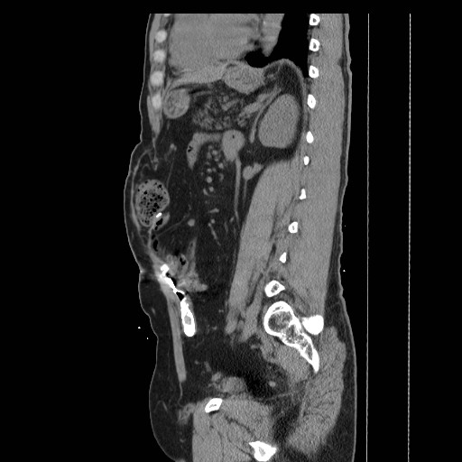 File:Colocutaneous fistula in Crohn's disease (Radiopaedia 29586-30093 F 27).jpg