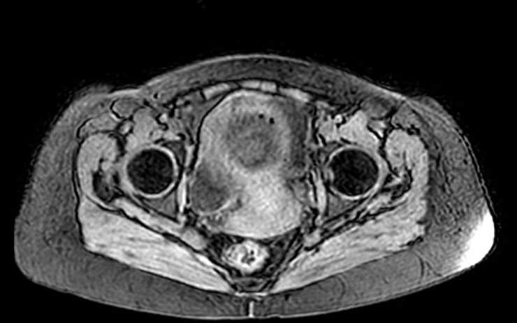 Colon adenocarcinoma with Krukenberg tumors, advanced pregnancy (Radiopaedia 67279-76645 A 13).jpg