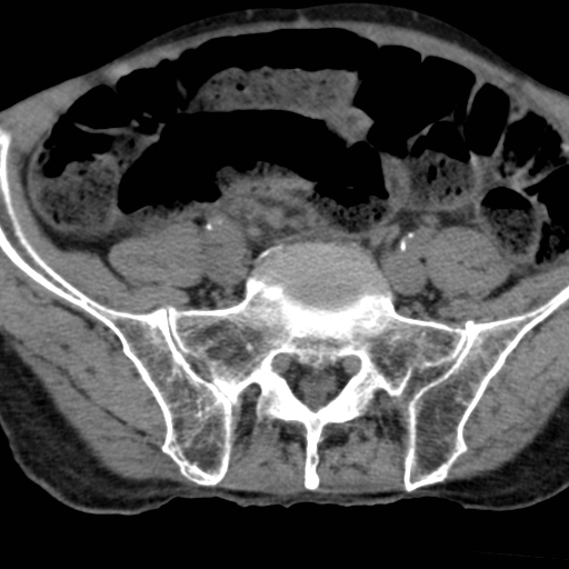 File:Colon cancer with calcified liver metastasis (Radiopaedia 74423-85309 Axial non-contrast 82).jpg