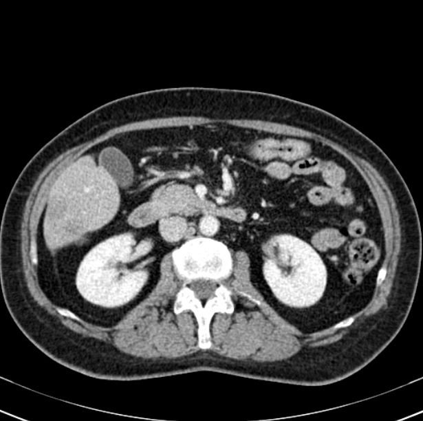 Colon carcinoma with hepatic metastases (Radiopaedia 29477-29961 A 48).jpg