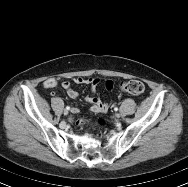 Colon carcinoma with hepatic metastases (Radiopaedia 29477-29961 A 91).jpg