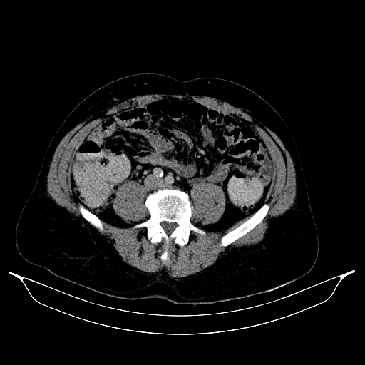 Colonic diverticulosis (Radiopaedia 72222-82744 A 62).jpg