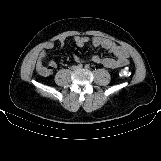 Colonic lipoma with colo-colic intussusception (Radiopaedia 58944-66200 Axial C+ rectal 42).jpg