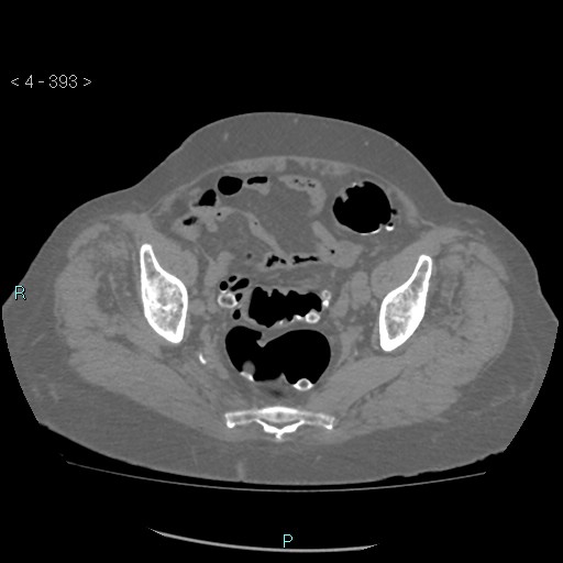 Colonic lipomas (Radiopaedia 49137-54244 Axial bone window 175).jpg