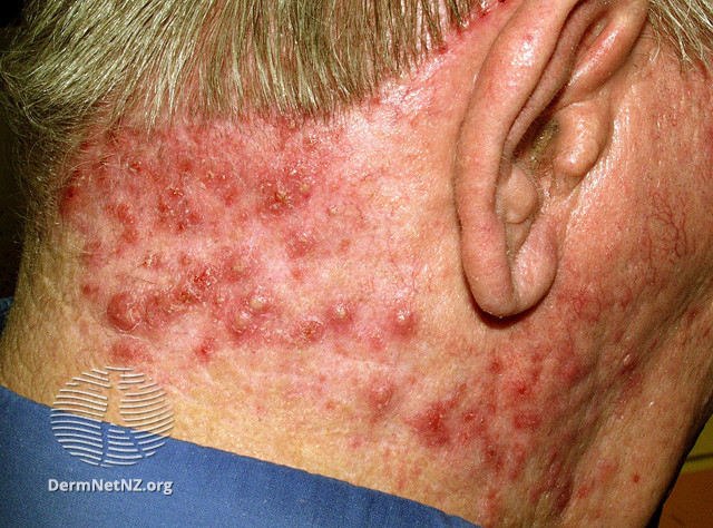 File:Folliculitis (DermNet NZ acne-s-folliculitis6).jpg