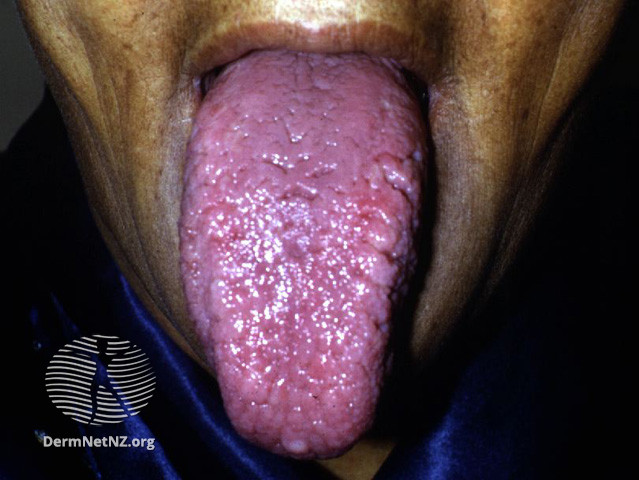 File:Macroglossia due to systemic amyloidosis (DermNet NZ systemic-amyloid6).jpg