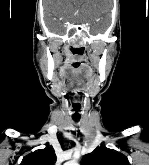 File:Nasopharyngeal carcinoma - infiltrating the clivus (Radiopaedia 62583-70875 D 17).jpg
