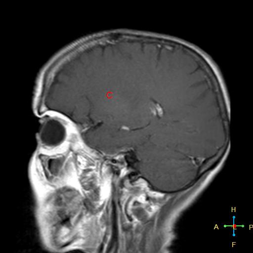 File:Nasopharyngeal carcinoma infiltrating the clivus (Radiopaedia 25229-25481 Sagittal T1 C+ 13).jpg