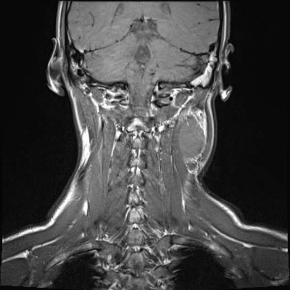 Nasopharyngeal carcinoma with skull base invasion (Radiopaedia 53415-59485 Coronal T1 6).jpg