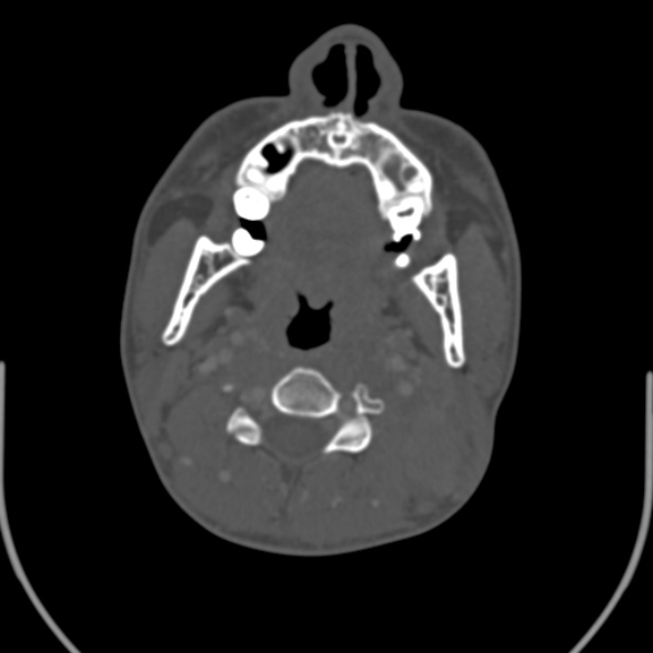 Nasopharyngeal carcinoma with skull base invasion (Radiopaedia 53415-59705 Axial bone window 89).jpg