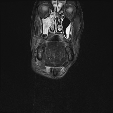 Nasopharyngeal carcinoma with skull base invasion (Radiopaedia 59258-66600 Coronal T2 fat sat 30).jpg
