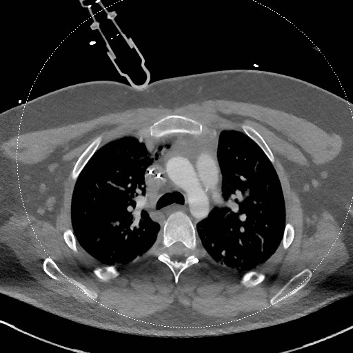 Neck CT angiogram (intraosseous vascular access) (Radiopaedia 55481-61945 B 47).jpg