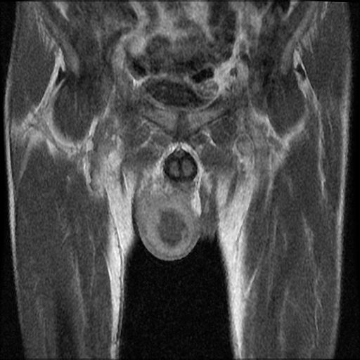 File:Necrotizing epididymo-orchitis with intra-testicular abscess (Radiopaedia 29397-29860 Coronal T1 C+ 9).jpg