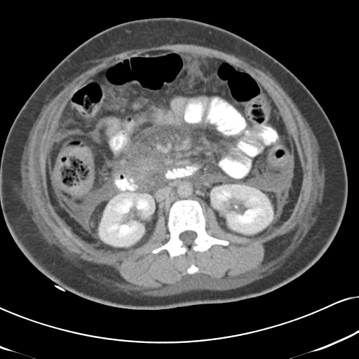 Necrotizing pancreatitis (Radiopaedia 50998-56540 A 36).png