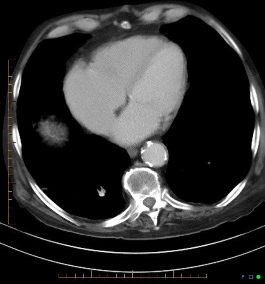 Necrotzing fasciitis due to a perforated adenocarcinoma of the splenic flexure (Radiopaedia 46930-51455 A 12).jpg