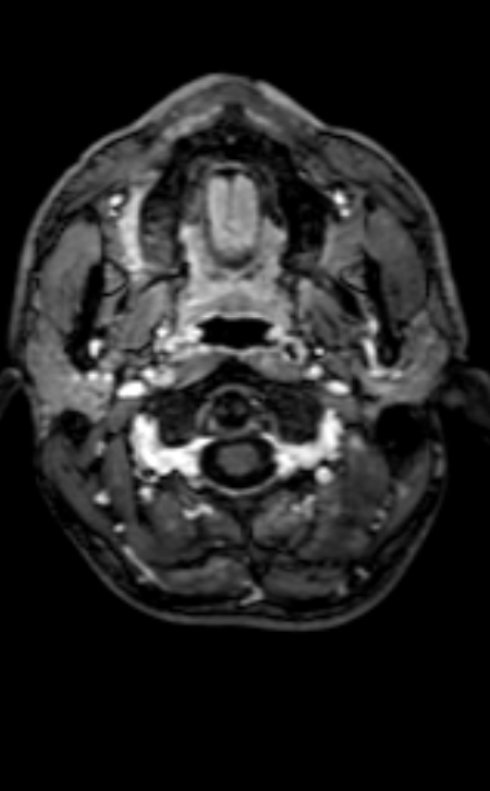 Neuro-Behçet disease (Radiopaedia 90112-107294 Axial T1 C+ 204).jpg