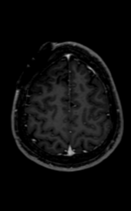 Neuro-Behçet disease (Radiopaedia 90112-107294 Axial T1 C+ 75).jpg