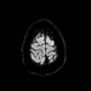File:Neuro-Behcet's disease (Radiopaedia 21557-21506 Axial DWI 25).jpg