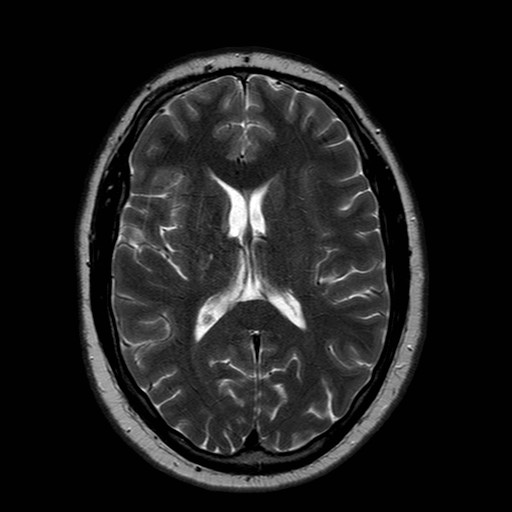 File:Neuro-Behcet's disease (Radiopaedia 21557-21506 Axial T2 16).jpg