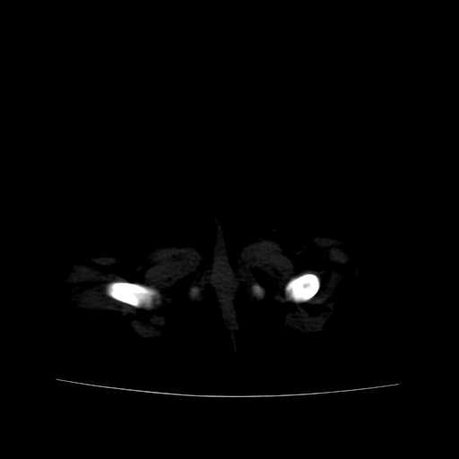 File:Neuroblastoma (Radiopaedia 20876-20799 Axial bone window 26).jpg