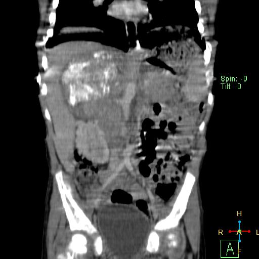 File:Neuroblastoma (Radiopaedia 24751-25016 B 14).jpg