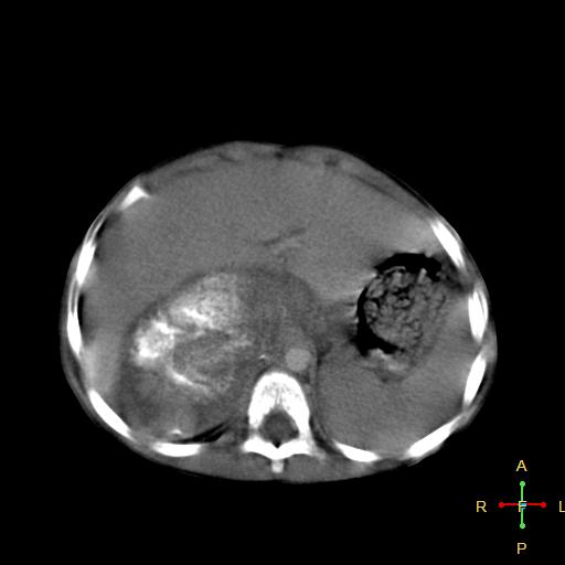 File:Neuroblastoma (Radiopaedia 24751-25016 D 7).jpg