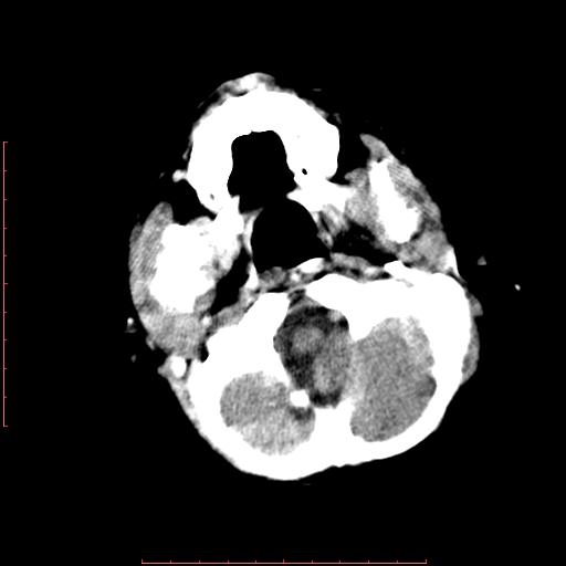 File:Neuroblastoma skull metastasis (Radiopaedia 56053-62683 Axial non-contrast 3).jpg