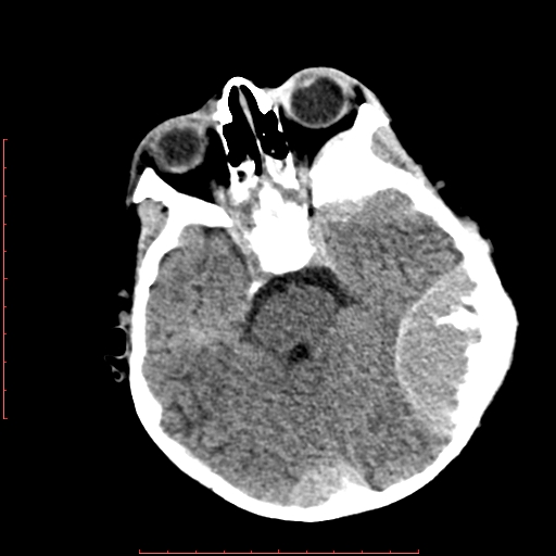 File:Neuroblastoma skull metastasis (Radiopaedia 56053-62683 Axial non-contrast 6).jpg