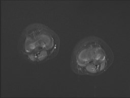 File:Neuroblastoma with bone metastases (Radiopaedia 67080-76414 Axial STIR 5).jpg