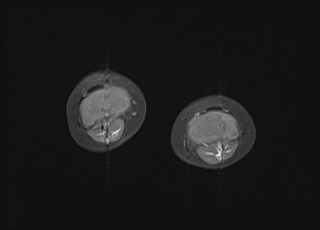 File:Neuroblastoma with bone metastases (Radiopaedia 67080-76414 Axial T1 C+ fat sat 3).jpg